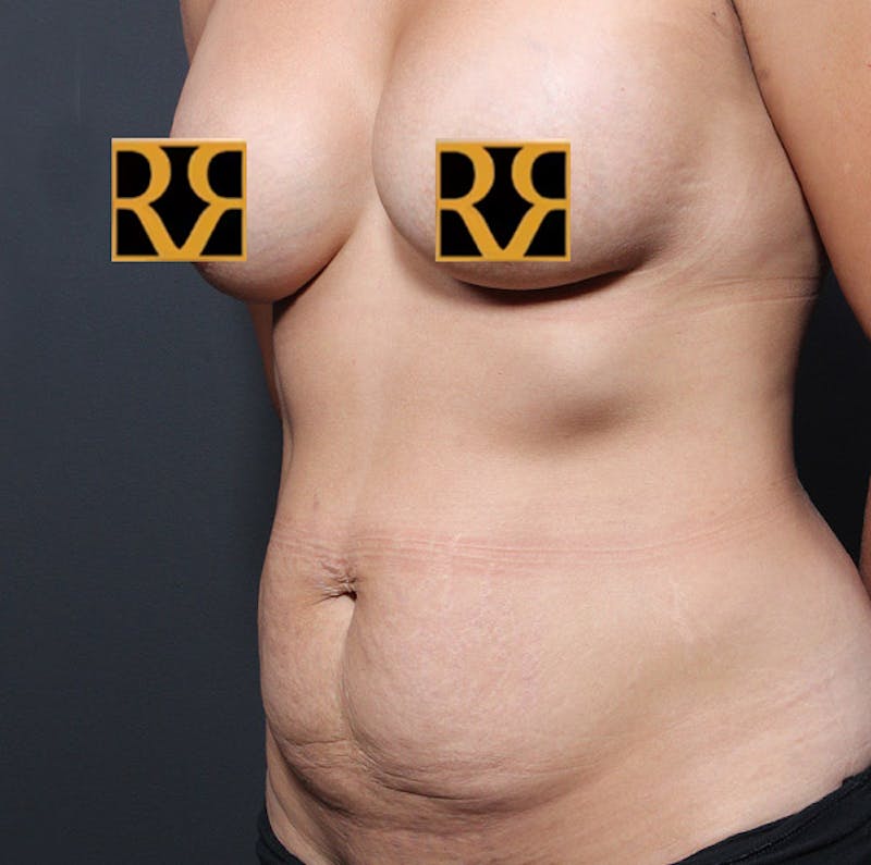 Tummy Tuck Before & After Gallery - Patient 303593 - Image 7