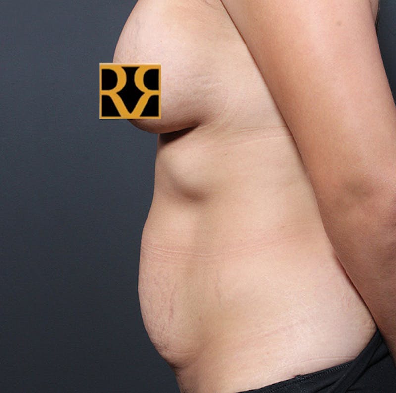 Tummy Tuck Before & After Gallery - Patient 303593 - Image 9