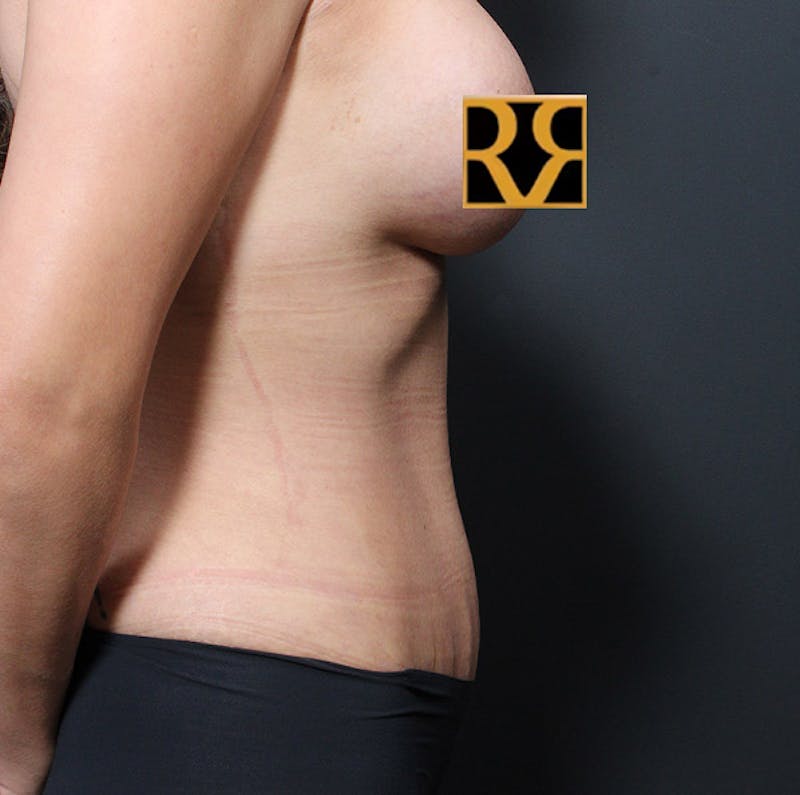 Tummy Tuck Before & After Gallery - Patient 303593 - Image 6