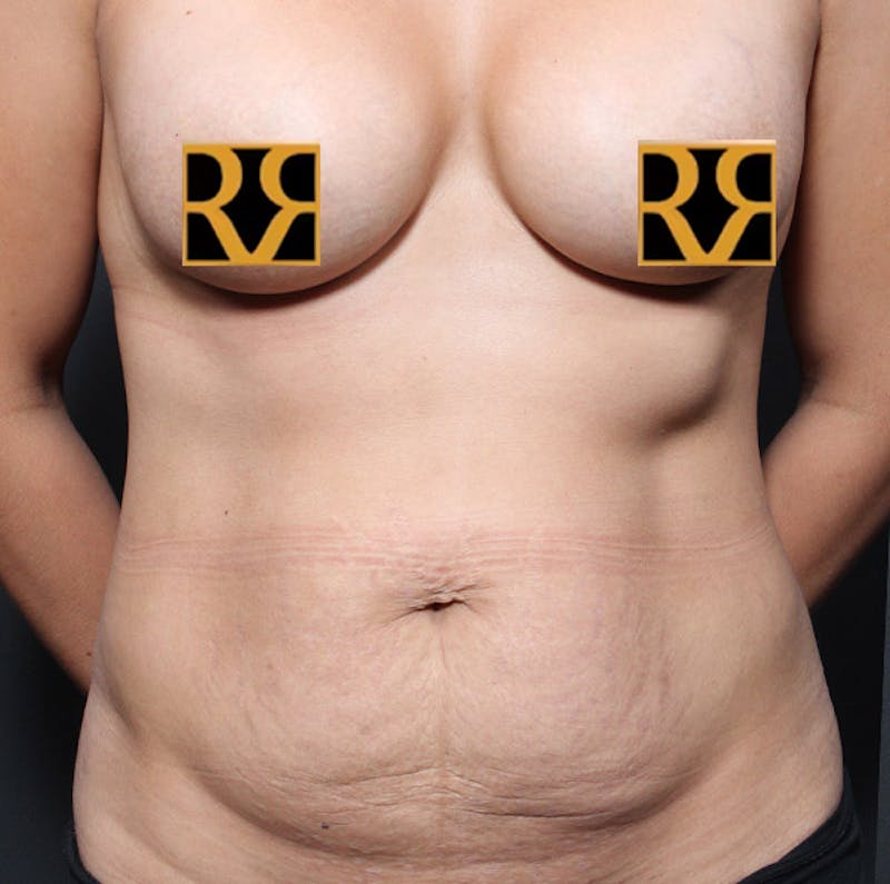 Tummy Tuck Before & After Gallery - Patient 303593 - Image 1