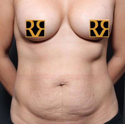 Tummy Tuck Before & After Gallery - Patient 303593 - Image 1