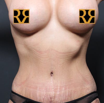 Tummy Tuck Before & After Gallery - Patient 303593 - Image 2