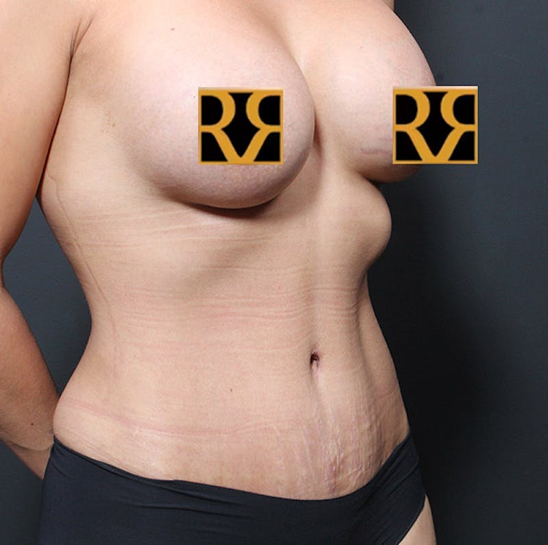 Tummy Tuck Before & After Gallery - Patient 303593 - Image 4