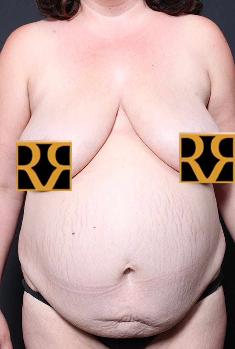Tummy Tuck Before & After Gallery - Patient 968605 - Image 1