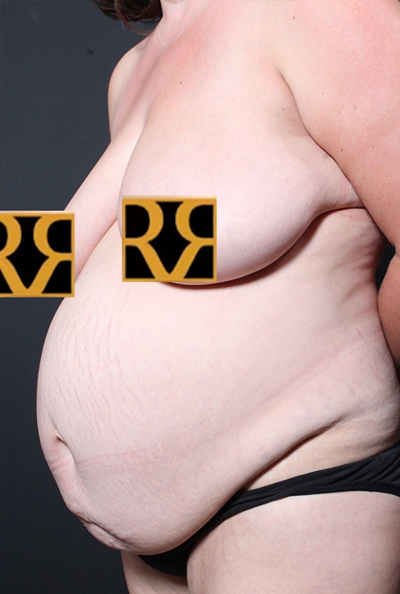 Tummy Tuck Before & After Gallery - Patient 968605 - Image 3