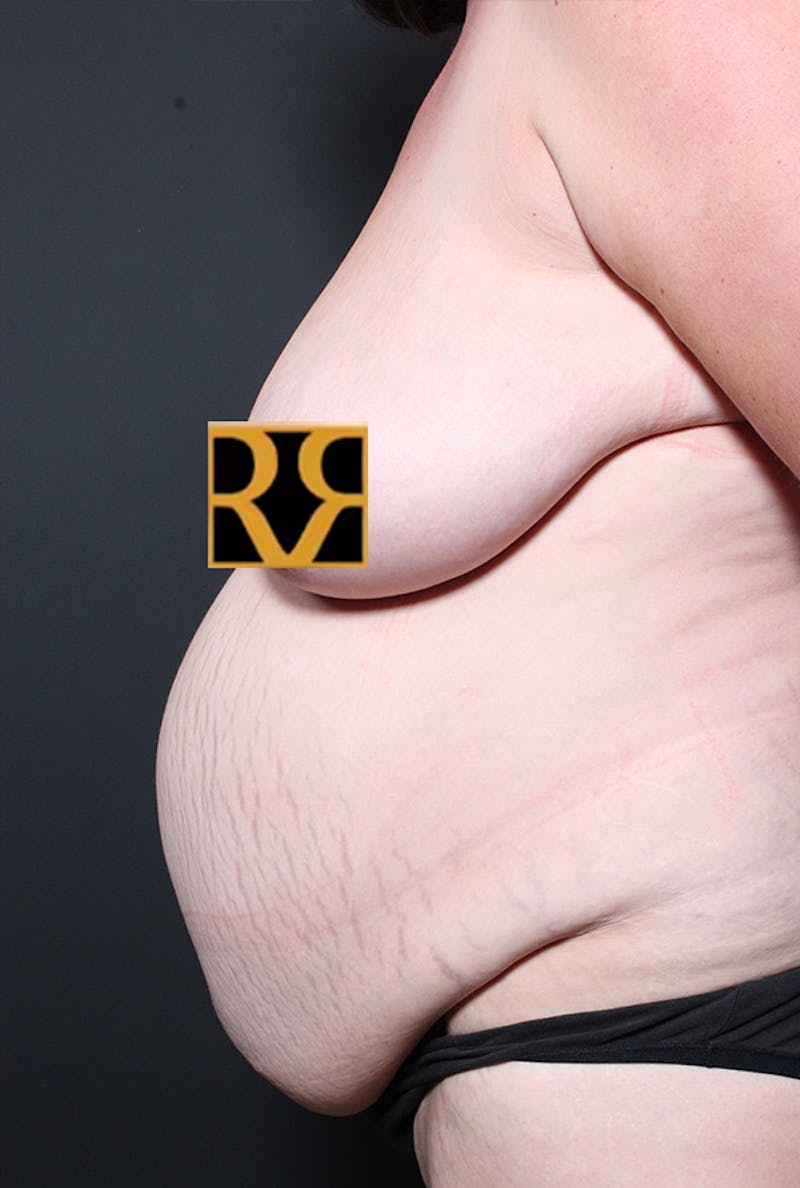 Tummy Tuck Before & After Gallery - Patient 968605 - Image 5