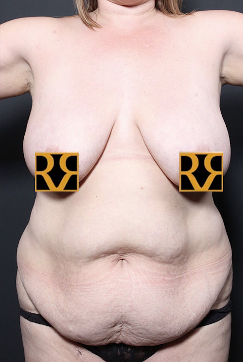 Tummy Tuck Before & After Gallery - Patient 215442 - Image 1