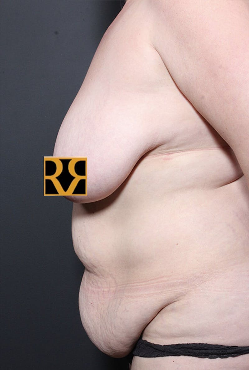 Tummy Tuck Before & After Gallery - Patient 215442 - Image 5