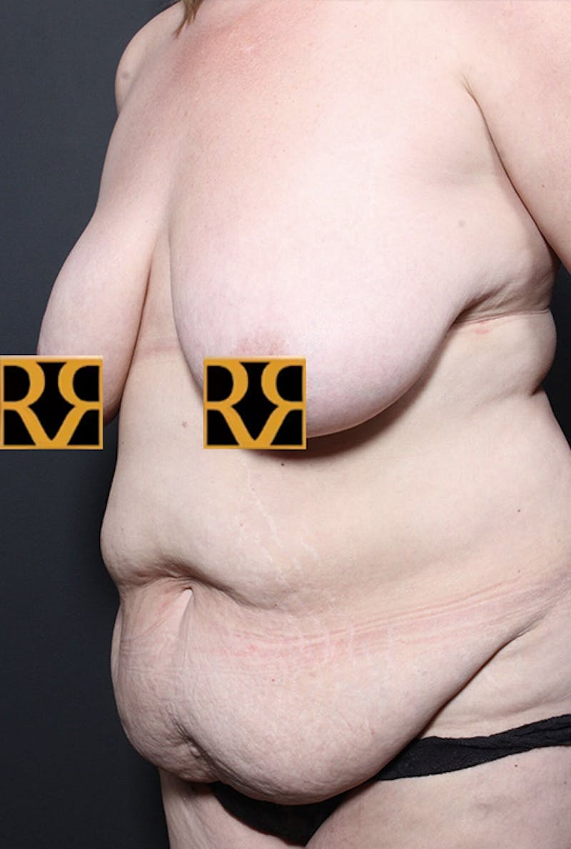 Tummy Tuck Before & After Gallery - Patient 215442 - Image 3