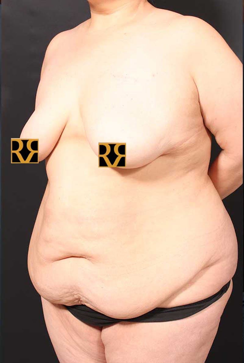 Tummy Tuck Before & After Gallery - Patient 770091 - Image 7