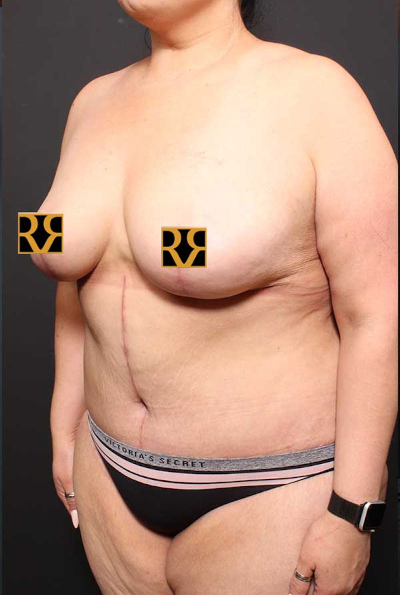 Tummy Tuck Before & After Gallery - Patient 770091 - Image 8