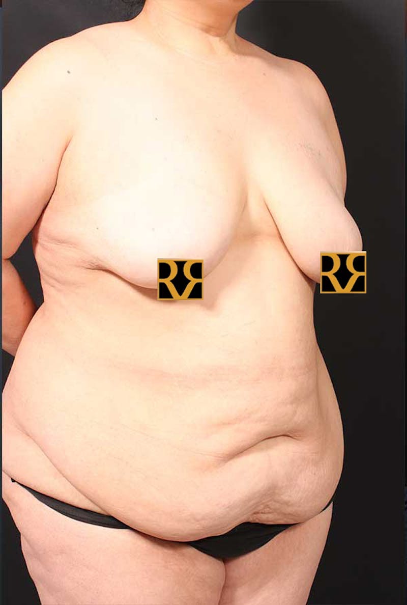 Tummy Tuck Before & After Gallery - Patient 770091 - Image 3