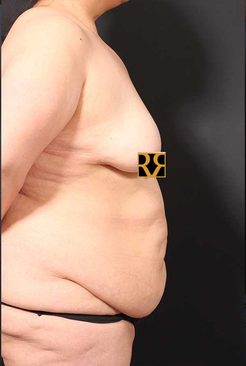 Tummy Tuck Before & After Gallery - Patient 770091 - Image 5