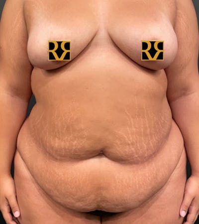 Tummy Tuck Before & After Gallery - Patient 252222 - Image 2