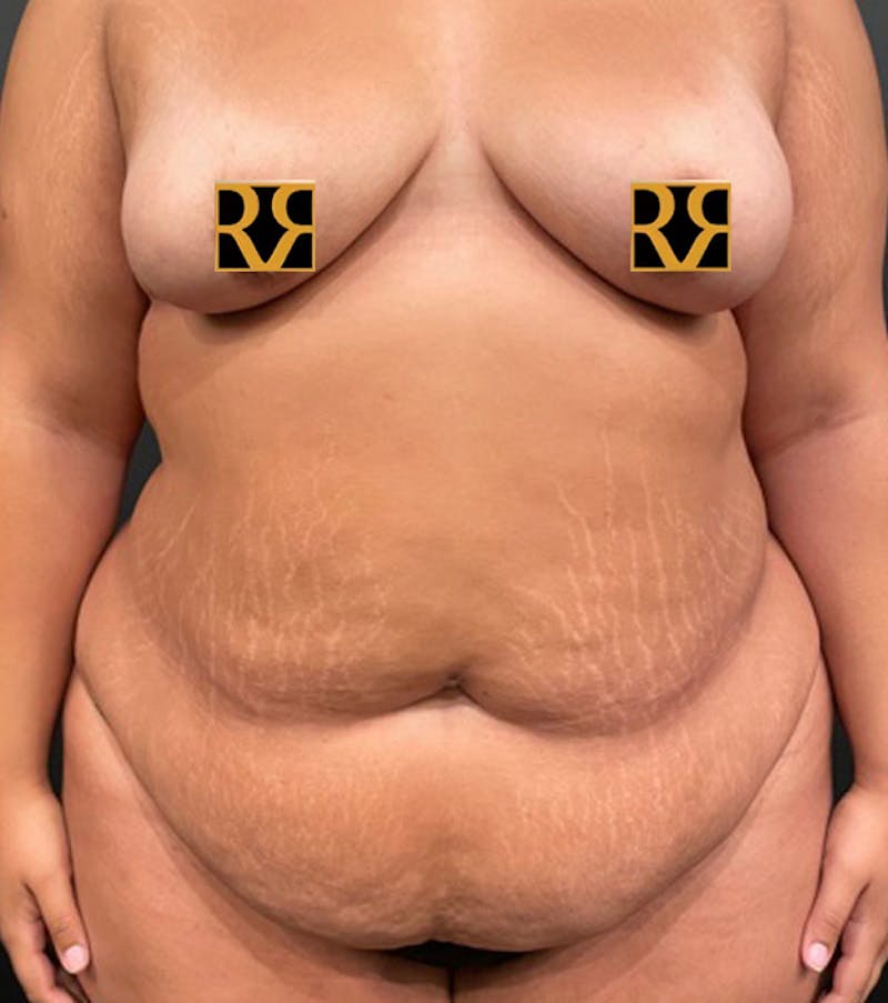 Tummy Tuck Before & After Gallery - Patient 252222 - Image 2