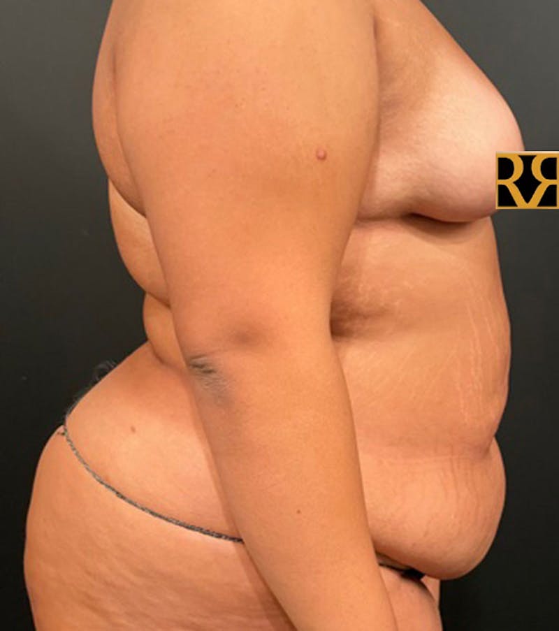Tummy Tuck Before & After Gallery - Patient 252222 - Image 6