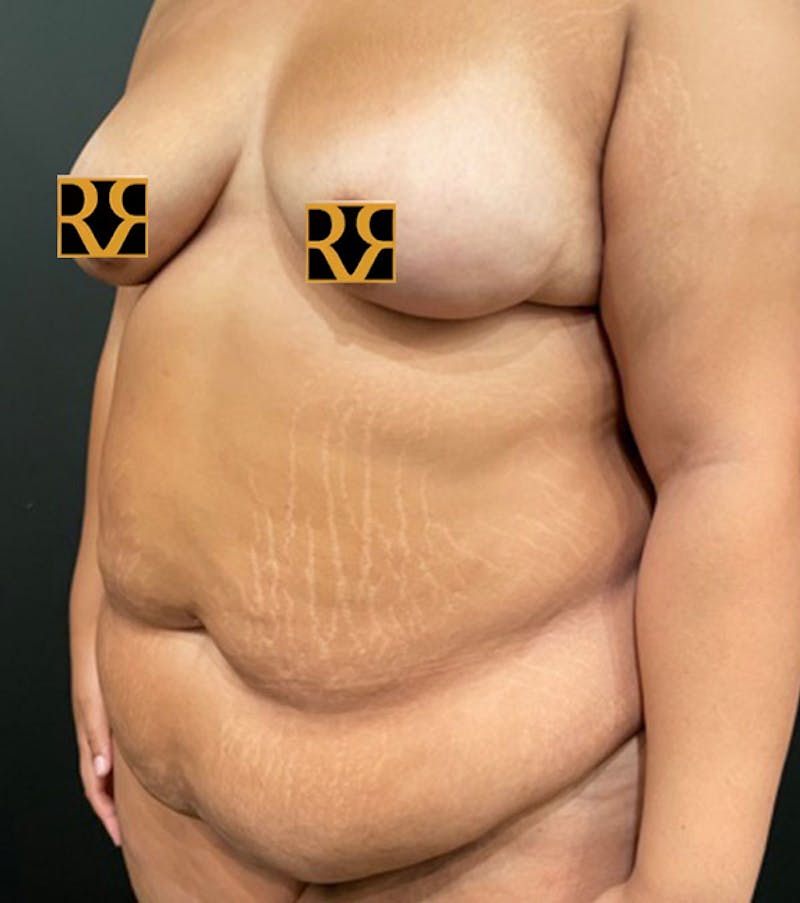 Tummy Tuck Before & After Gallery - Patient 252222 - Image 8