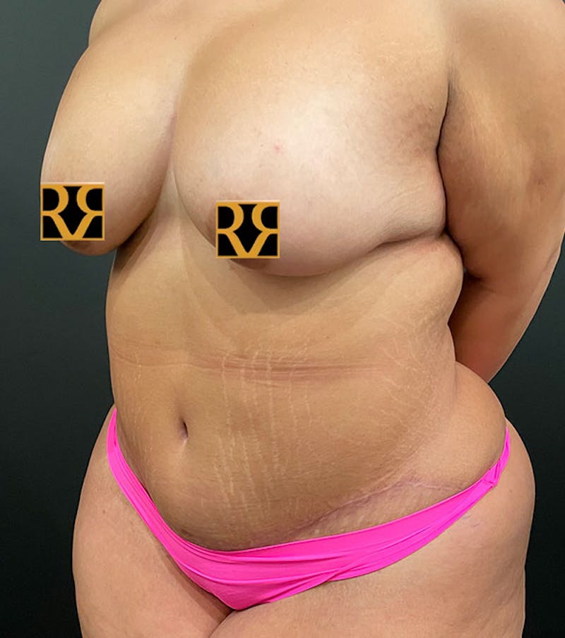 Tummy Tuck Before & After Gallery - Patient 252222 - Image 9