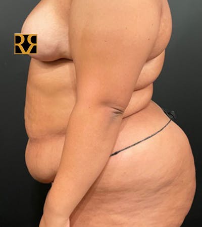 Tummy Tuck Before & After Gallery - Patient 252222 - Image 1