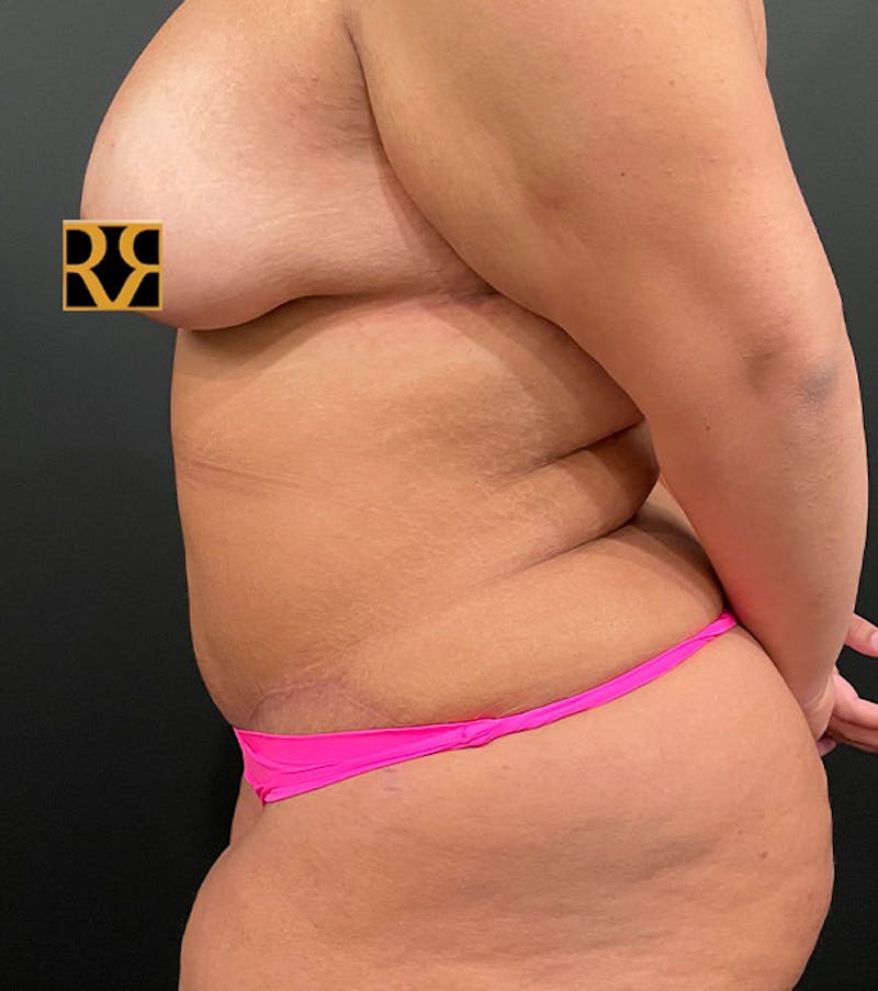 Tummy Tuck Before & After Gallery - Patient 252222 - Image 7