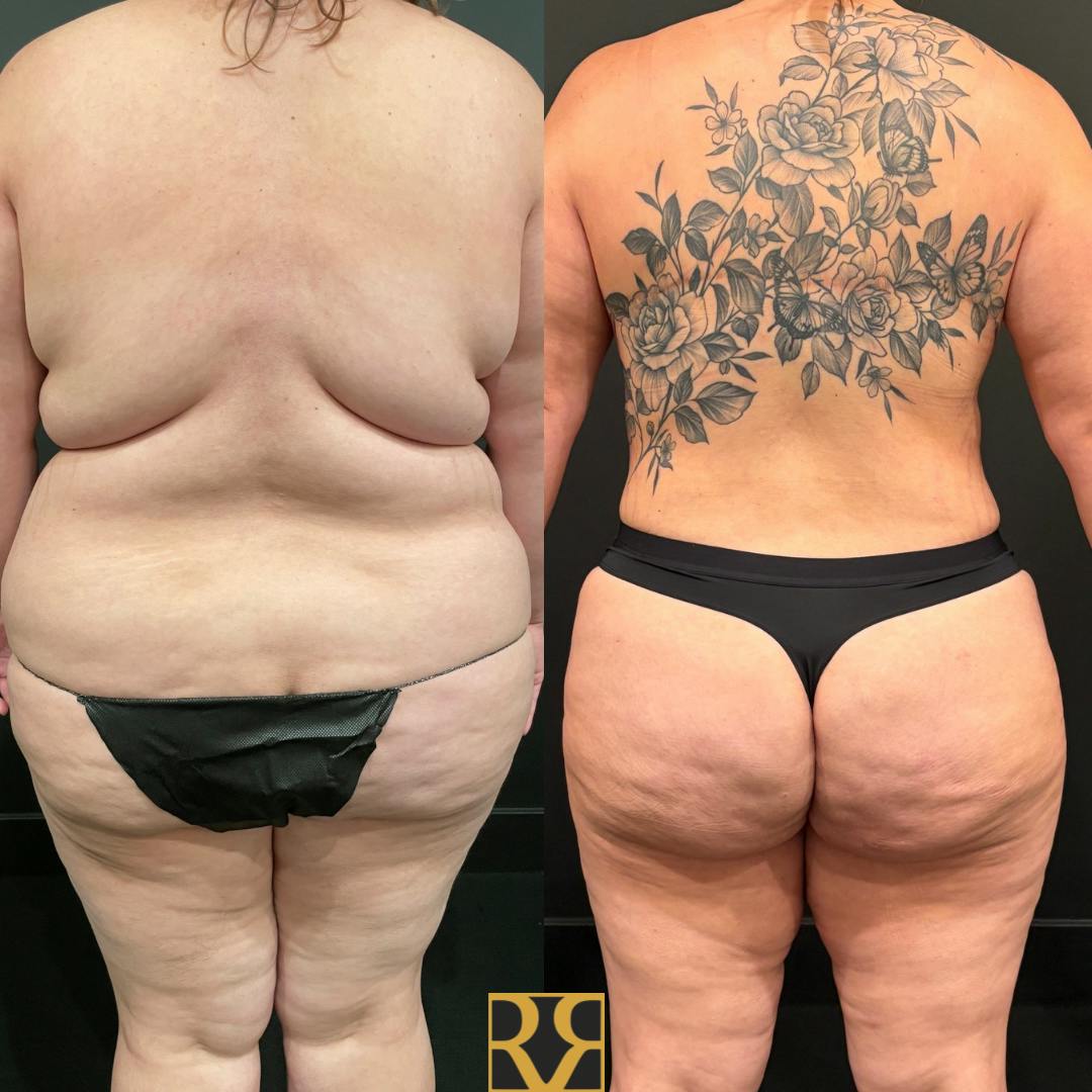 Bra Line Back Lift ™ Before & After Gallery - Patient 220319 - Image 1