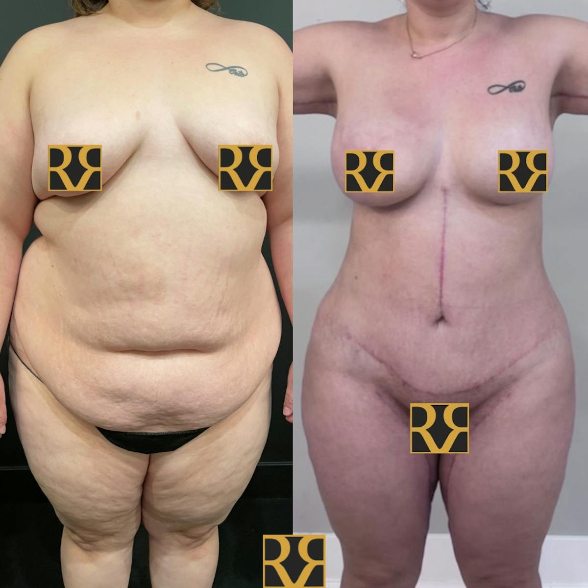 Bra Line Back Lift ™ Before & After Gallery - Patient 220319 - Image 2