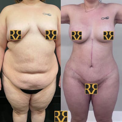 Plus Size Tummy Tuck ® Before & After Gallery - Patient 212233 - Image 1