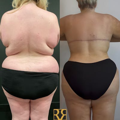 Bra Line Back Lift ™ Before & After Gallery - Patient 209549 - Image 1