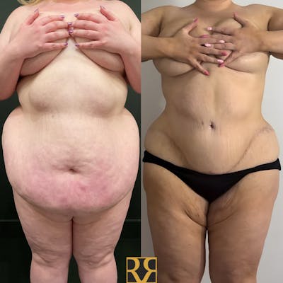 Plus Size Tummy Tuck ® Before & After Gallery - Patient 230083 - Image 1