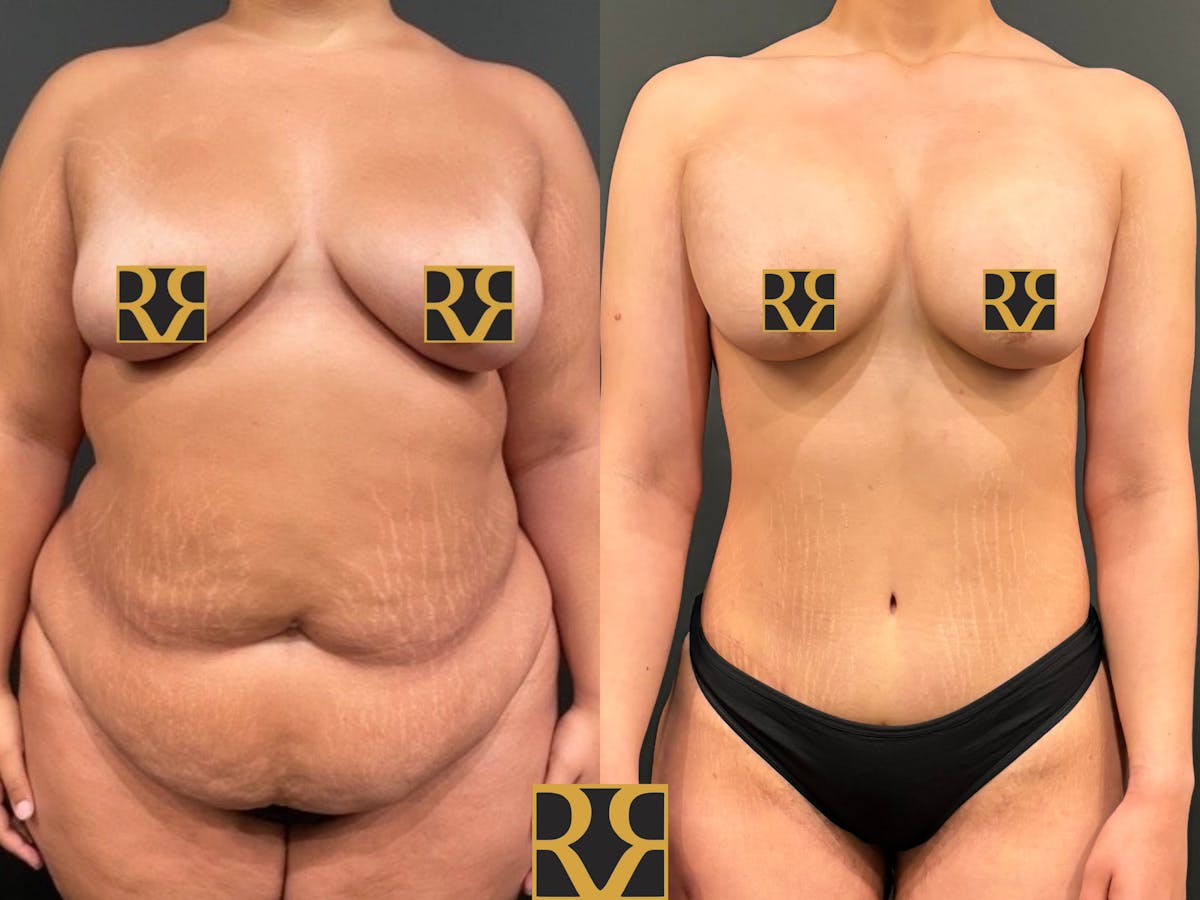 Arm Lift Before & After Gallery - Patient 363162 - Image 1