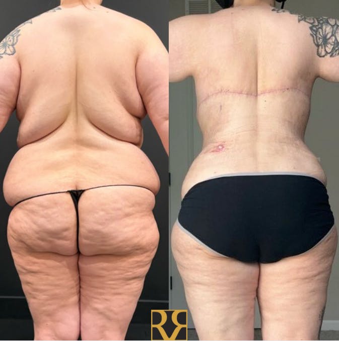 Bra Line Back Lift ™ Before & After Gallery - Patient 229991 - Image 2