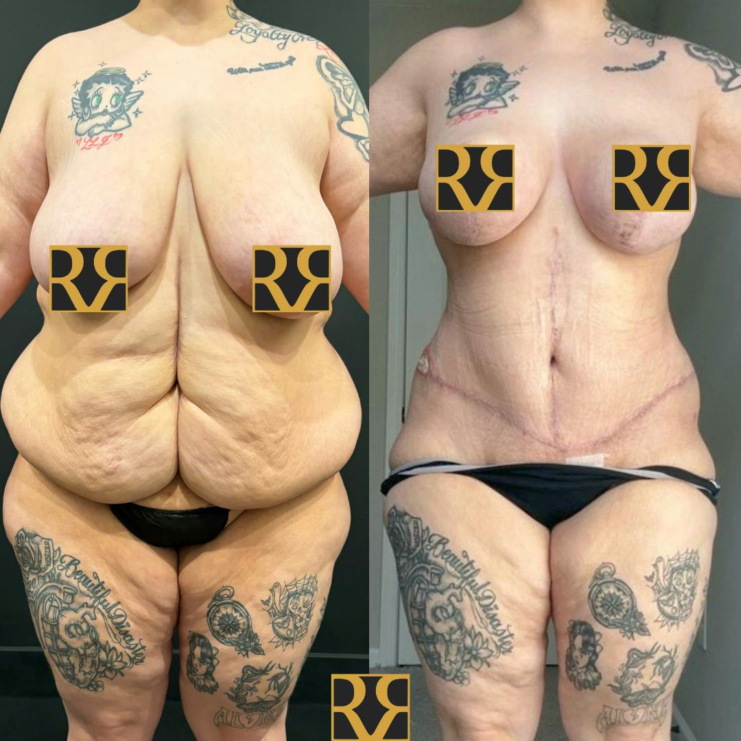 Bra Line Back Lift ™ Before & After Gallery - Patient 229991 - Image 1