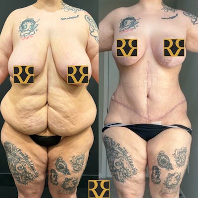 Plus Size Tummy Tuck ® Before & After Gallery - Patient 173601 - Image 1