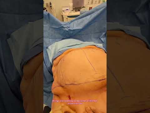 A person in. surgery