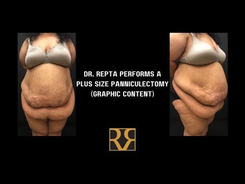 surgery before and after