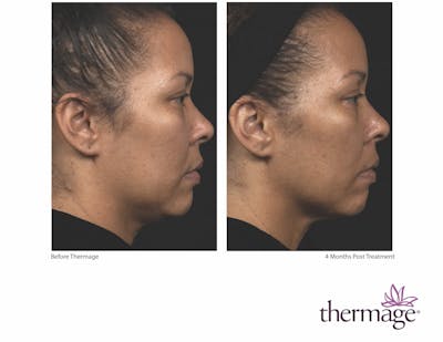 Thermage FLX Before & After Gallery - Patient 160931162 - Image 1