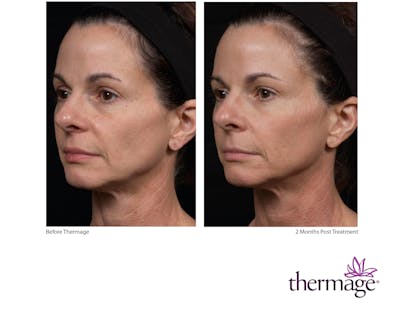 Thermage FLX Before & After Gallery - Patient 160931163 - Image 1