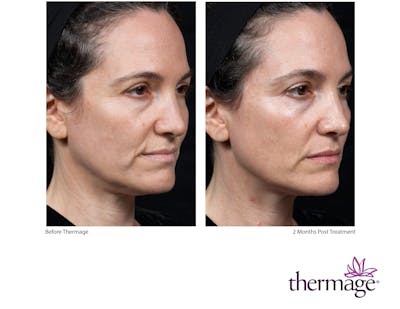 Thermage FLX Before & After Gallery - Patient 160931164 - Image 1