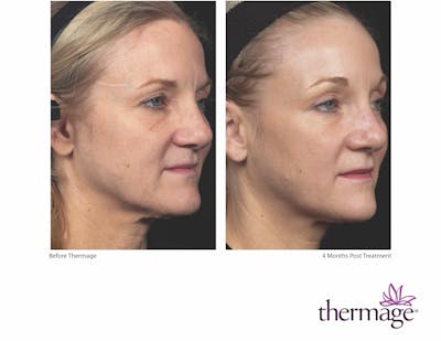 Thermage FLX Before & After Gallery - Patient 160931165 - Image 1