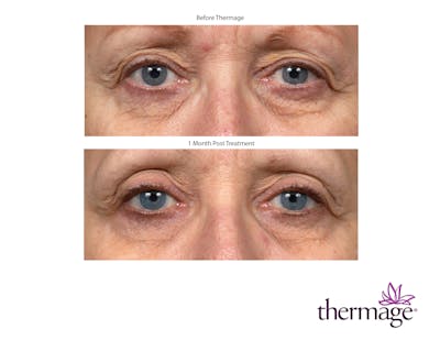 Thermage FLX Before & After Gallery - Patient 160931166 - Image 1