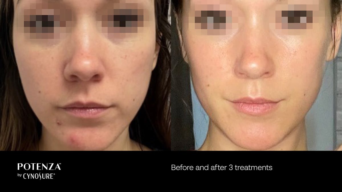 Potenza RF Microneedling Before & After Gallery - Patient 160931217 - Image 1