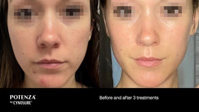Potenza RF Microneedling Before & After Gallery - Patient 160931217 - Image 1