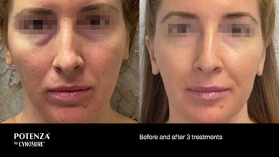 Potenza RF Microneedling Before & After Gallery - Patient 160931218 - Image 1