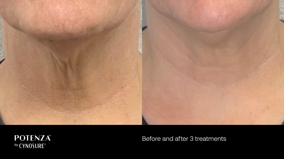 Potenza RF Microneedling Before & After Gallery - Patient 160931219 - Image 1