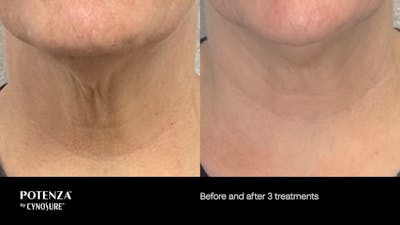 Potenza RF Microneedling Before & After Gallery - Patient 160931219 - Image 1