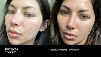 Potenza RF Microneedling Before & After Gallery - Patient 160931220 - Image 1