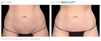 Emsculpt Neo Before & After Gallery - Patient 160932257 - Image 1