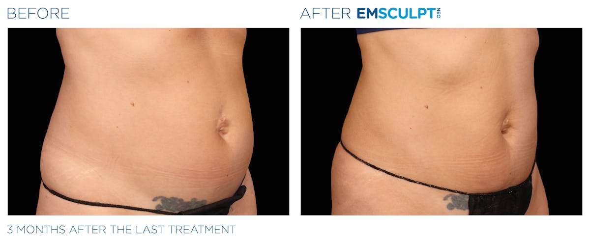 Emsculpt Neo Before & After Gallery - Patient 160932258 - Image 1