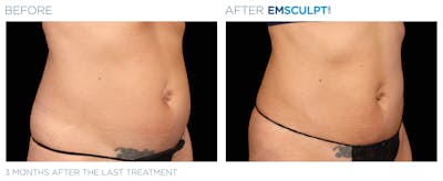 Emsculpt Neo Before & After Gallery - Patient 160932258 - Image 1