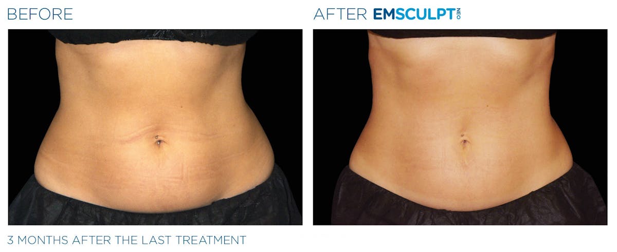 Emsculpt Neo Before & After Gallery - Patient 160932259 - Image 1